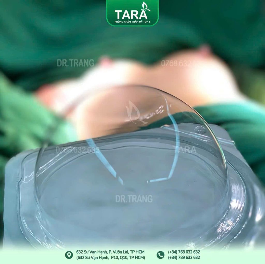 Thế nào là một ca nâng ngực đẹp? 5 tiêu chí bác sĩ thẩm mỹ thường dùng