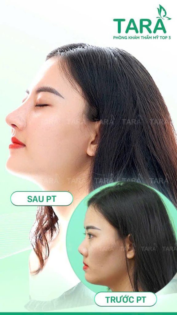 Combo căng da midface & nâng mũi: trẻ hóa gương mặt và hài hòa đường nét chỉ trong một lần phẫu thuật