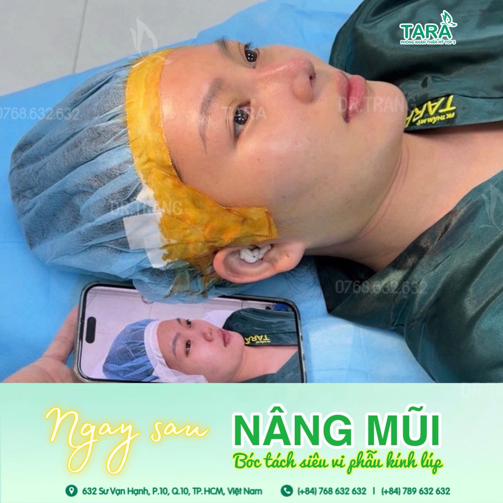 Khi nào cần sửa mũi sau nâng mũi không nẹp? Dấu hiệu nhận biết & mốc thời gian phù hợp