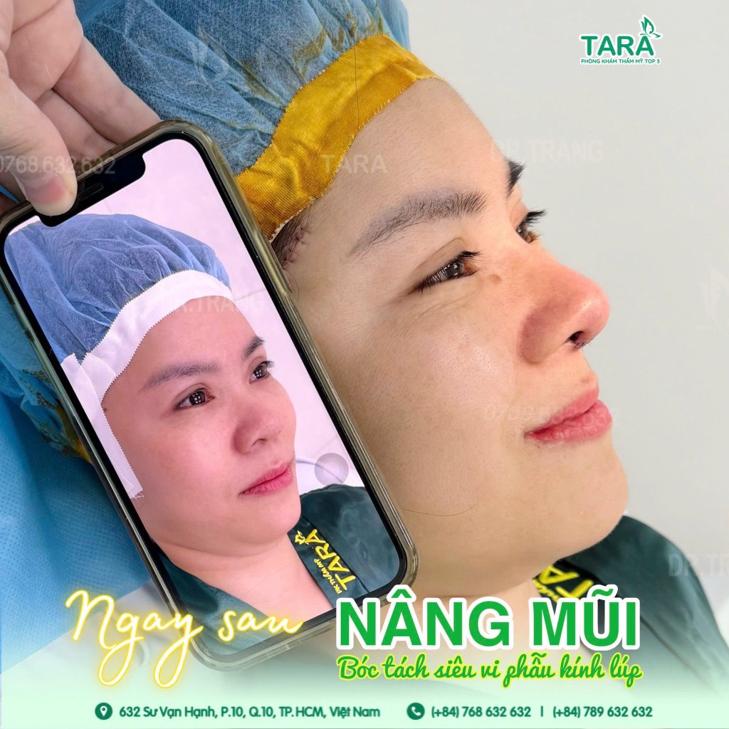 Nâng mũi không nẹp có an toàn không? Những rủi ro cần biết & cách hạn chế