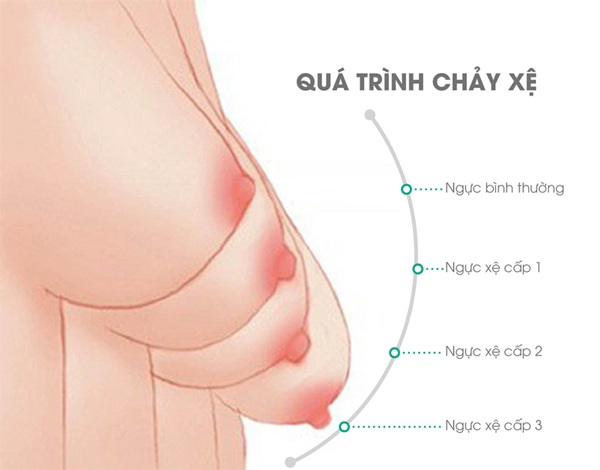Mẹ còn dự định sinh thêm bé có nên nâng ngực không