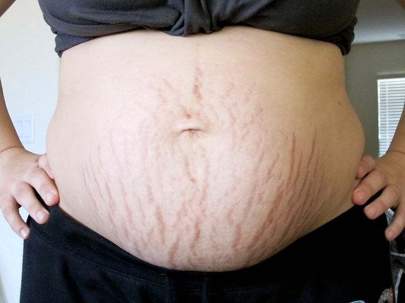 Tạo hình thành bụng cho mẹ bỉm: xử lý da thừa, rạn và cơ bụng tách sau sinh